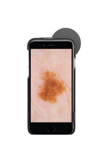 Picture of IC1 Digital Dermatoscope Kit IPhone 6/6S