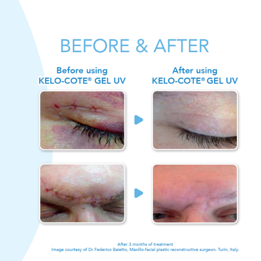 Picture of KELO-COTE 100ml Spray